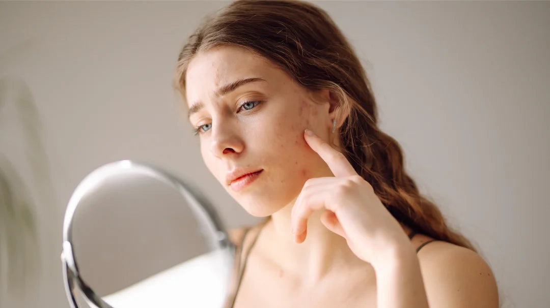 A woman gazes into a mirror, examining her face, which shows visible pimples and signs of concern