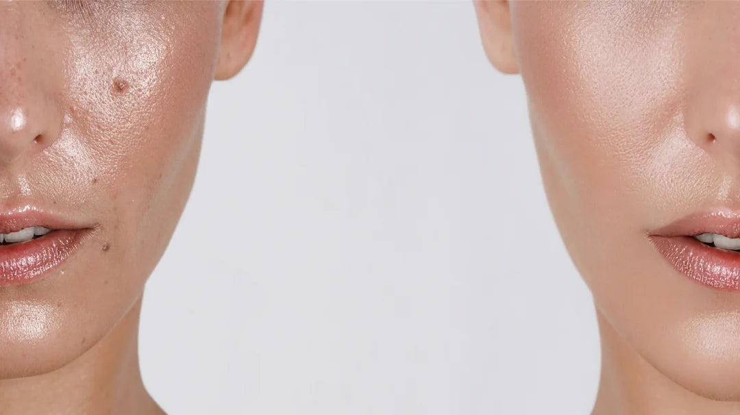 Before and after images showcasing a woman's transformation in skin clarity, highlighting significant improvement in acne condition.