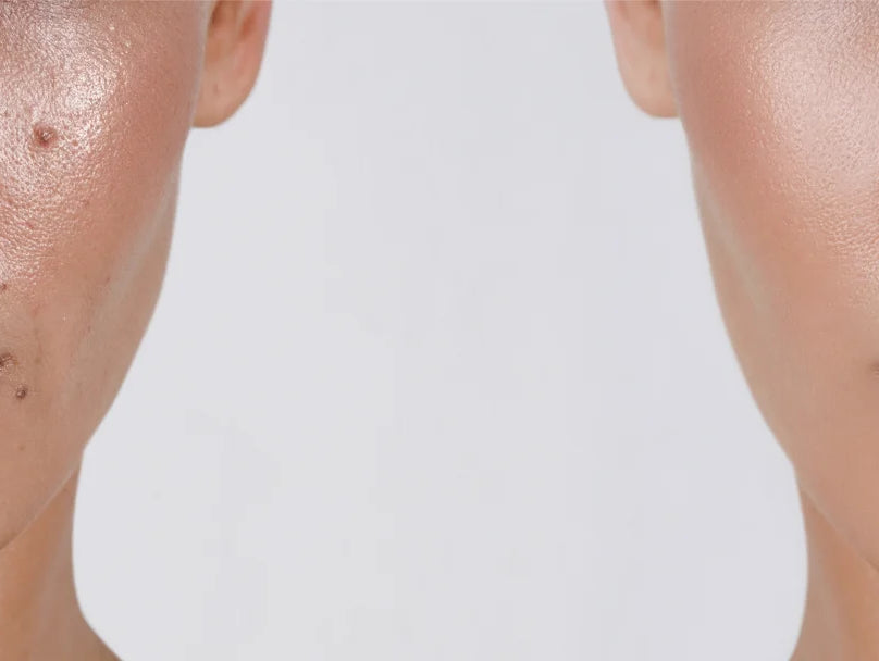 Before and after images showcasing a woman's transformation in skin clarity, highlighting significant improvement in acne condition.