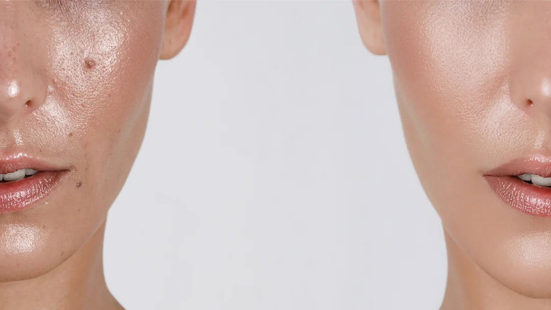 Before and after images showcasing a woman's transformation in skin clarity, highlighting significant improvement in acne condition.